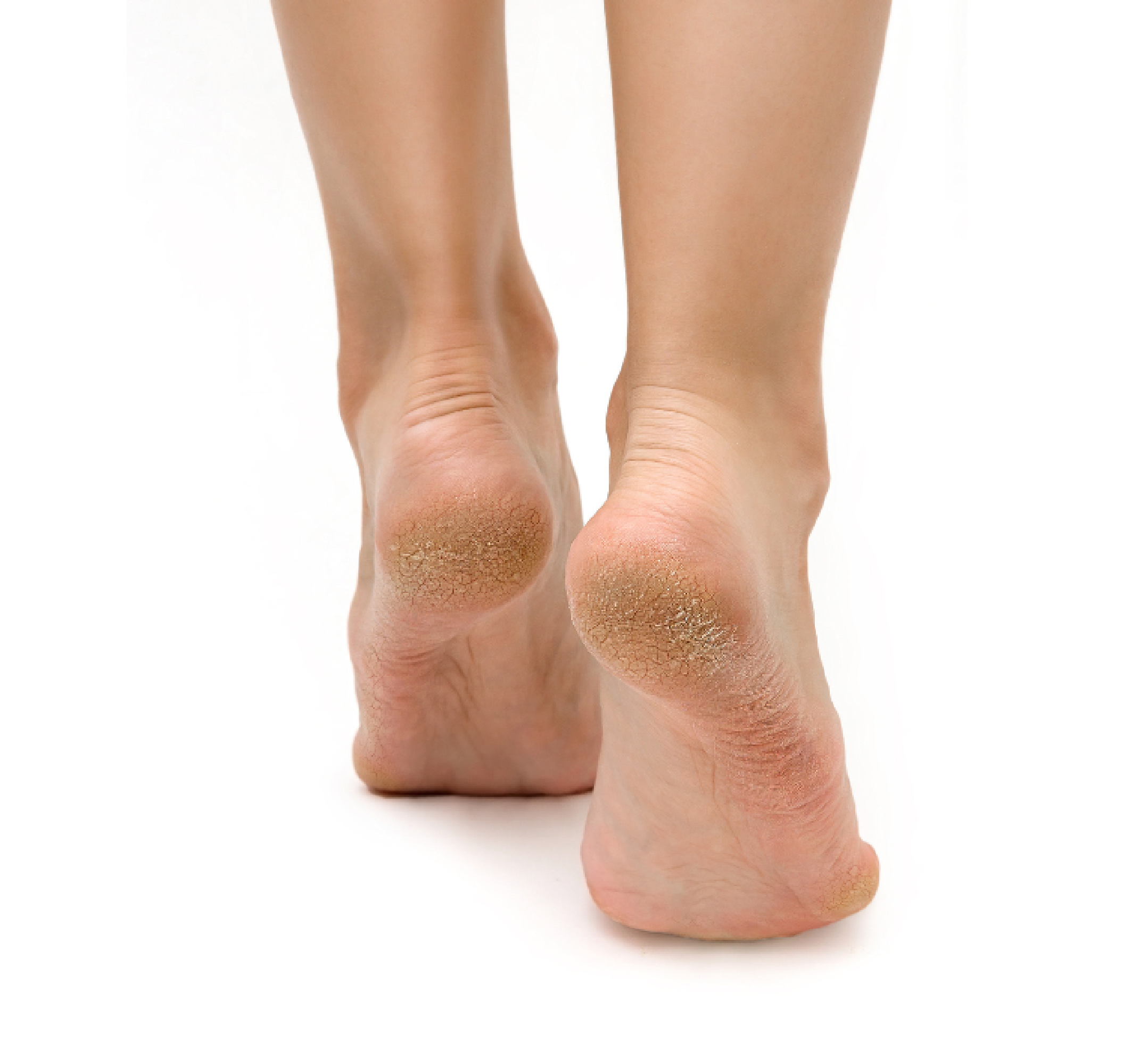 Feetcalm Callus & Hard Skin Spray 20% Urea Feetcalm Callus & Hard Skin Spray 20% Urea