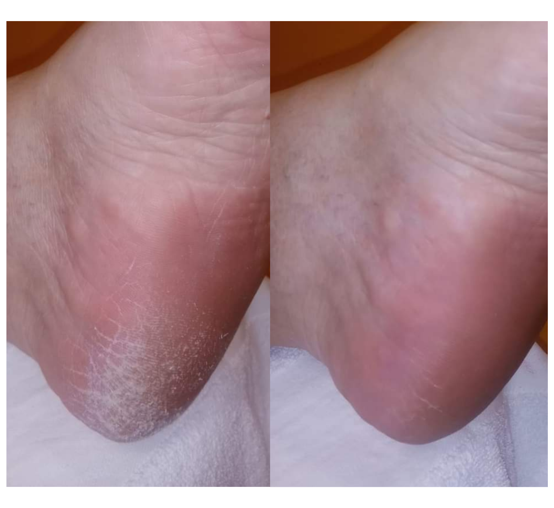 Feetcalm Callus & Hard Skin Spray 20% Urea Feetcalm Callus & Hard Skin Spray 20% Urea