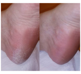 Feetcalm Callus & Hard Skin Spray 20% Urea Feetcalm Callus & Hard Skin Spray 20% Urea