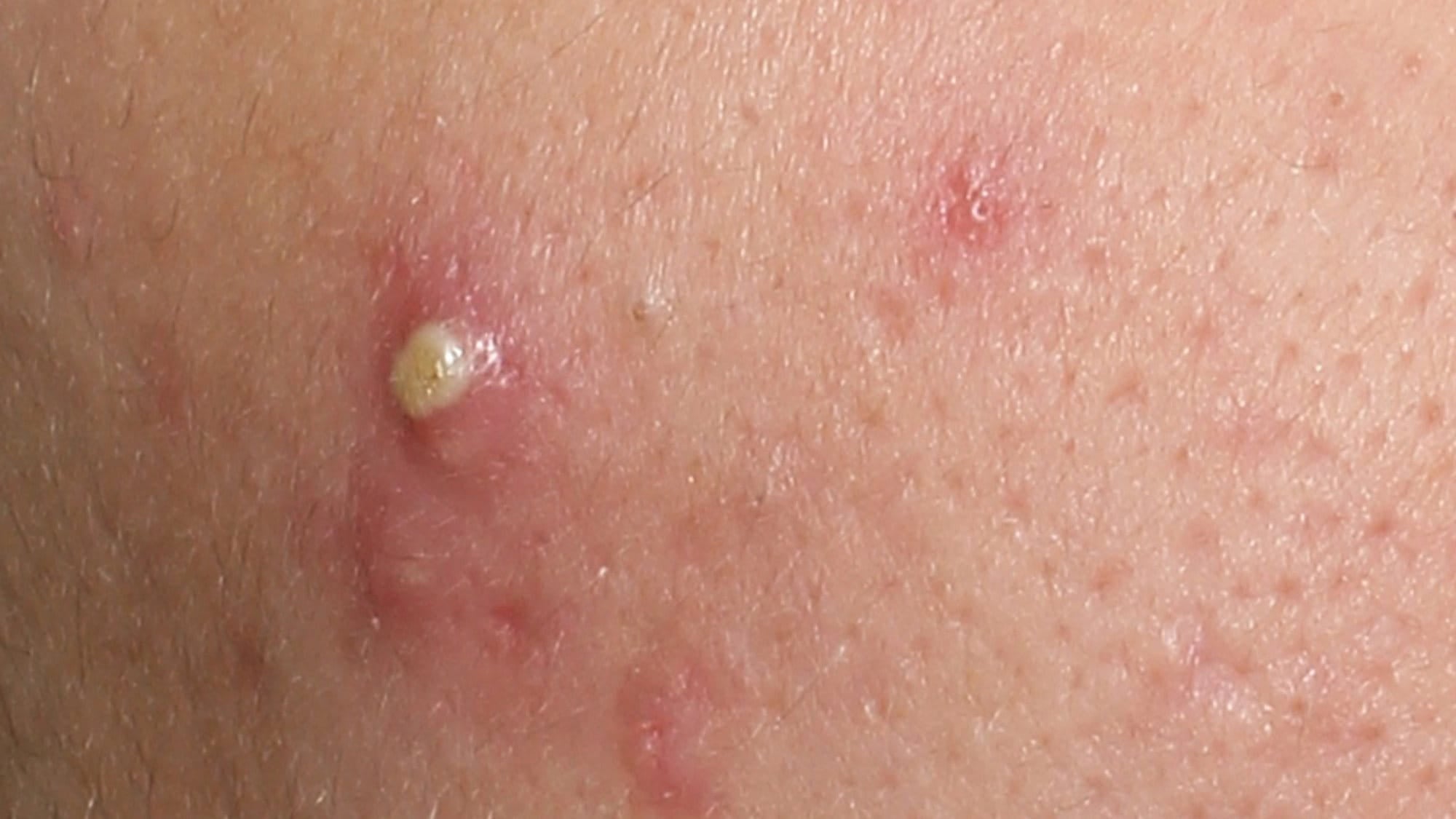 DERMOPURE CLINICAL TRIPLE ACTION