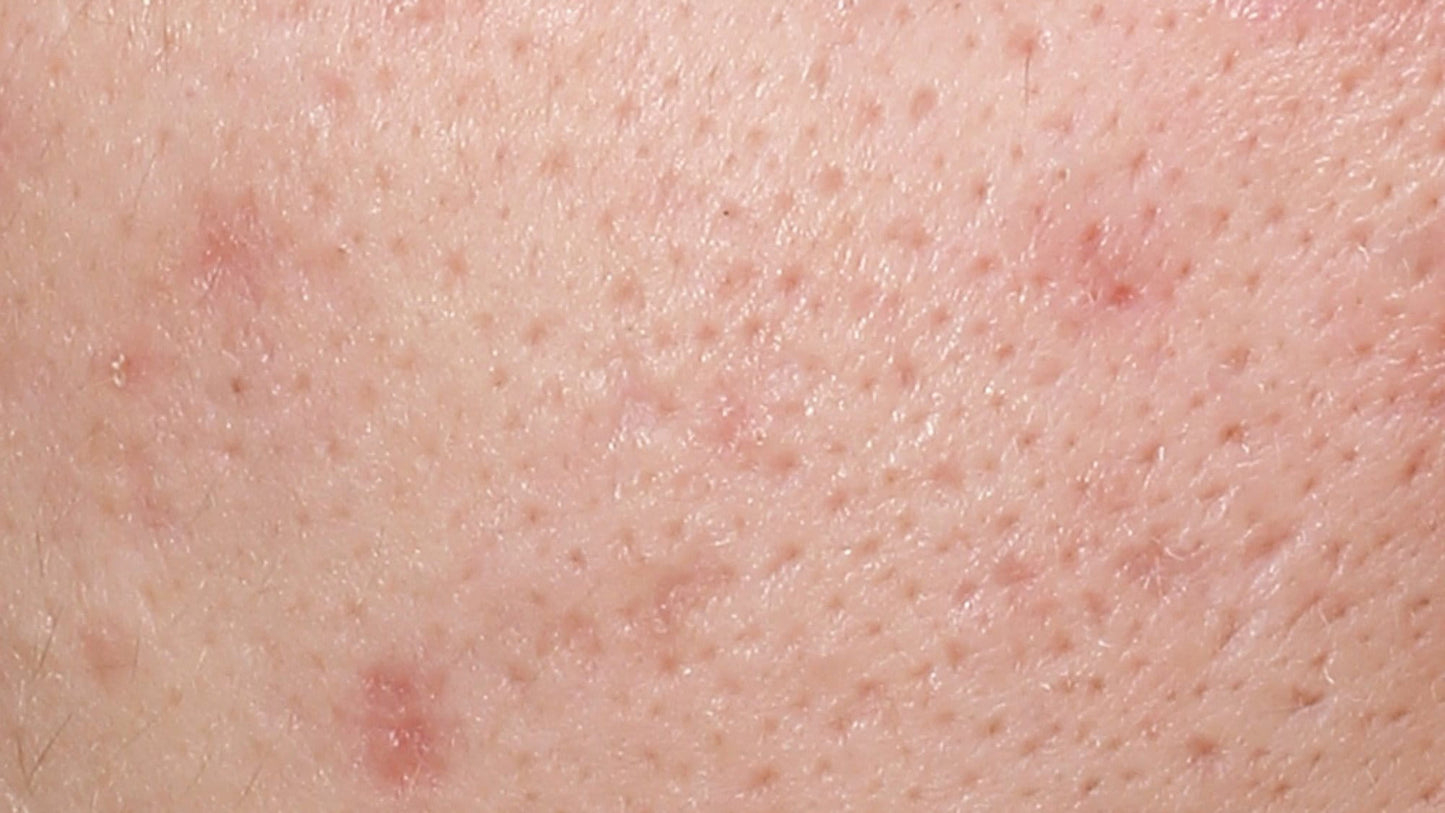 DERMOPURE CLINICAL TRIPLE ACTION