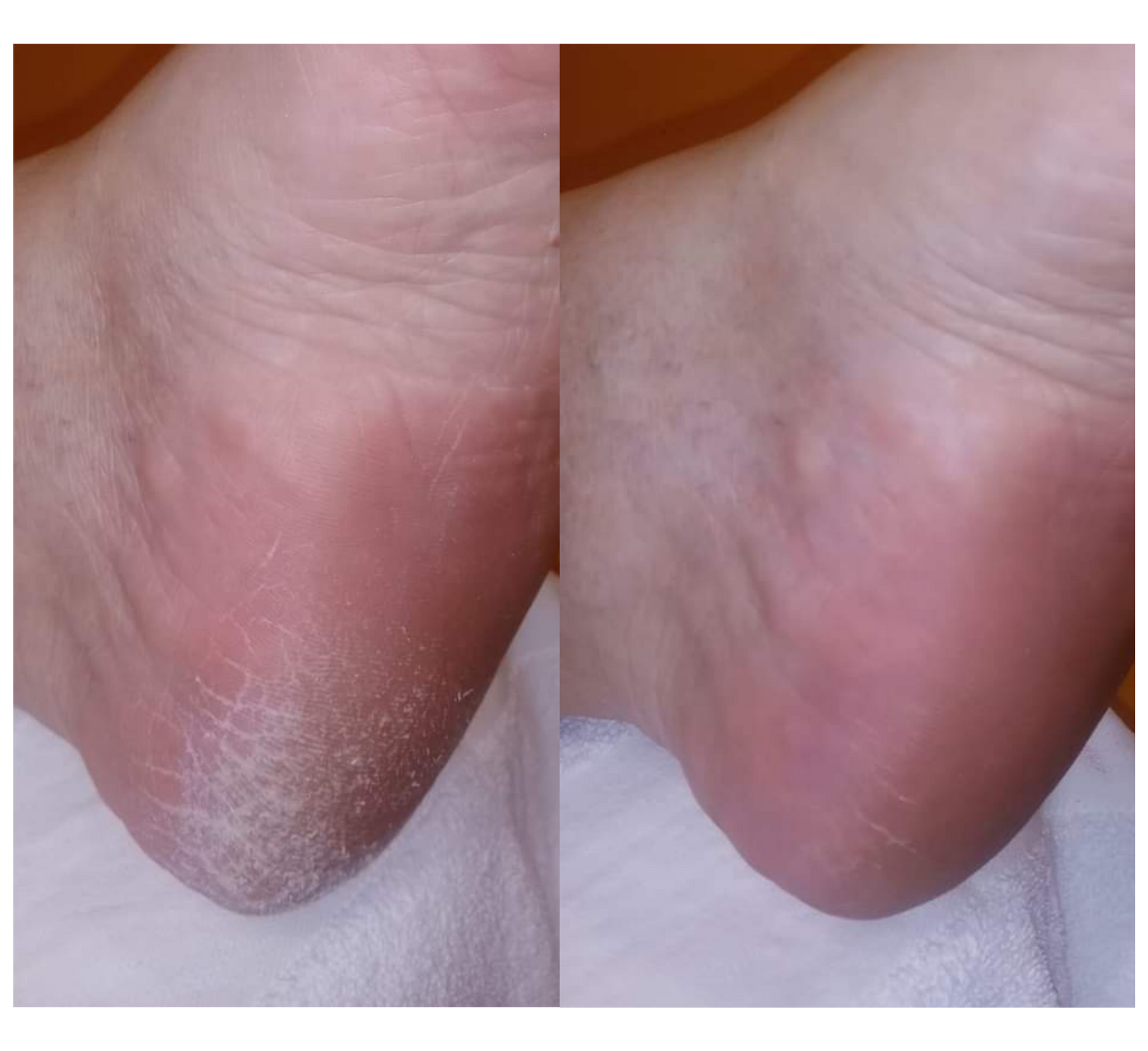 Sprej Feetcalm për kallo dhe lëkurë të fortë 20% ure