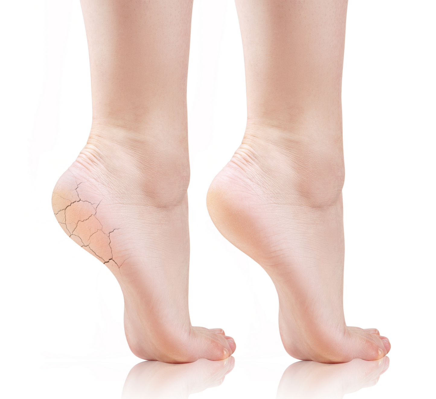 Shkumë për thembra të çara Feetcalm 25% ure