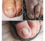 Sprej për riparimin e thonjve Feetcalm SOS *75ml