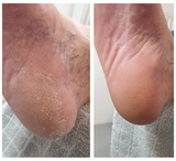 Shkumë hidratuese ultra-hidratuese Feetcalm 15% ure (lëkurë e thatë deri në shumë e thatë e irrituar)