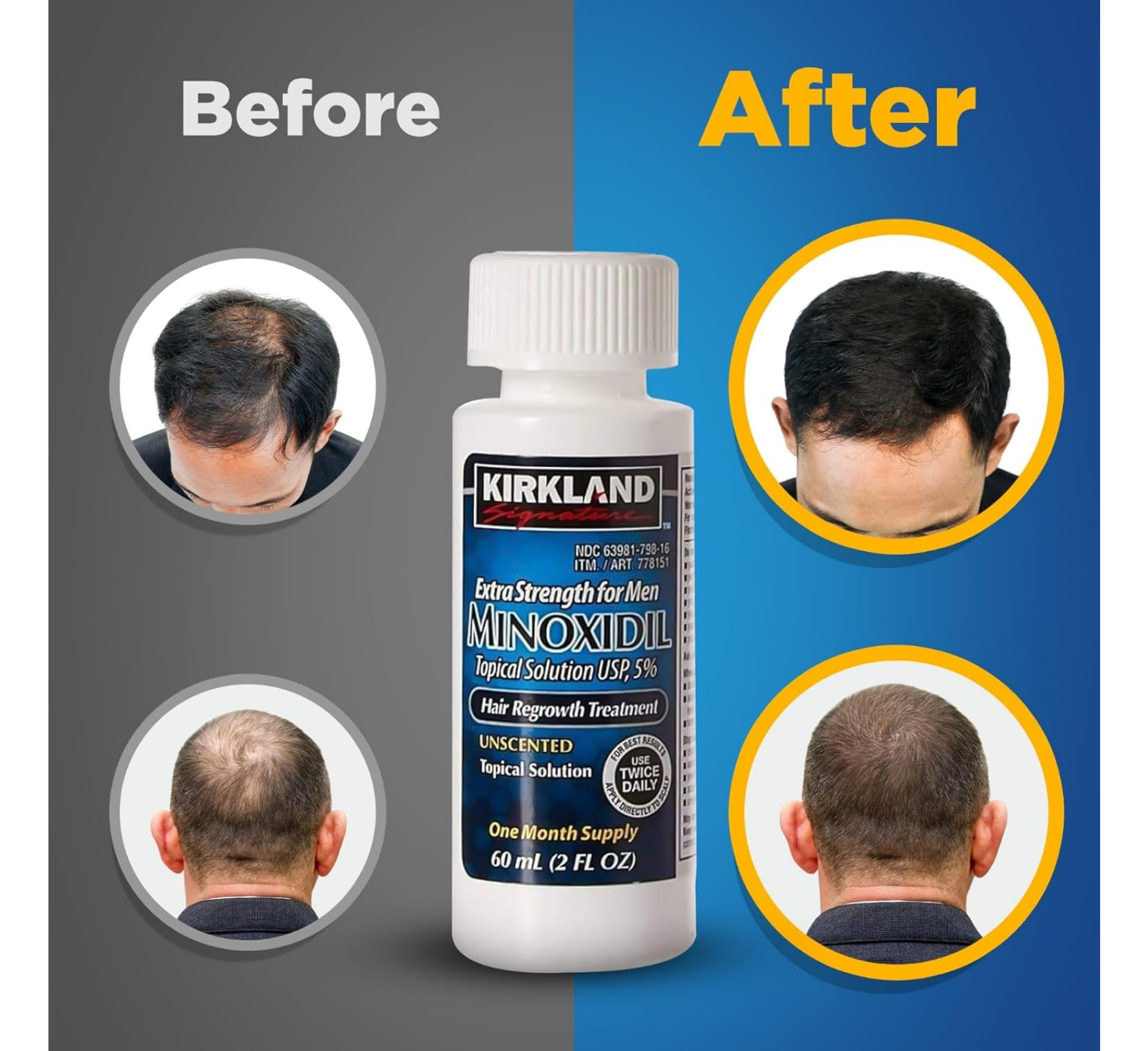 Minoxidil Topical Solution USP 5% - Hair Regrowth Treatment for Men (6x60ml)