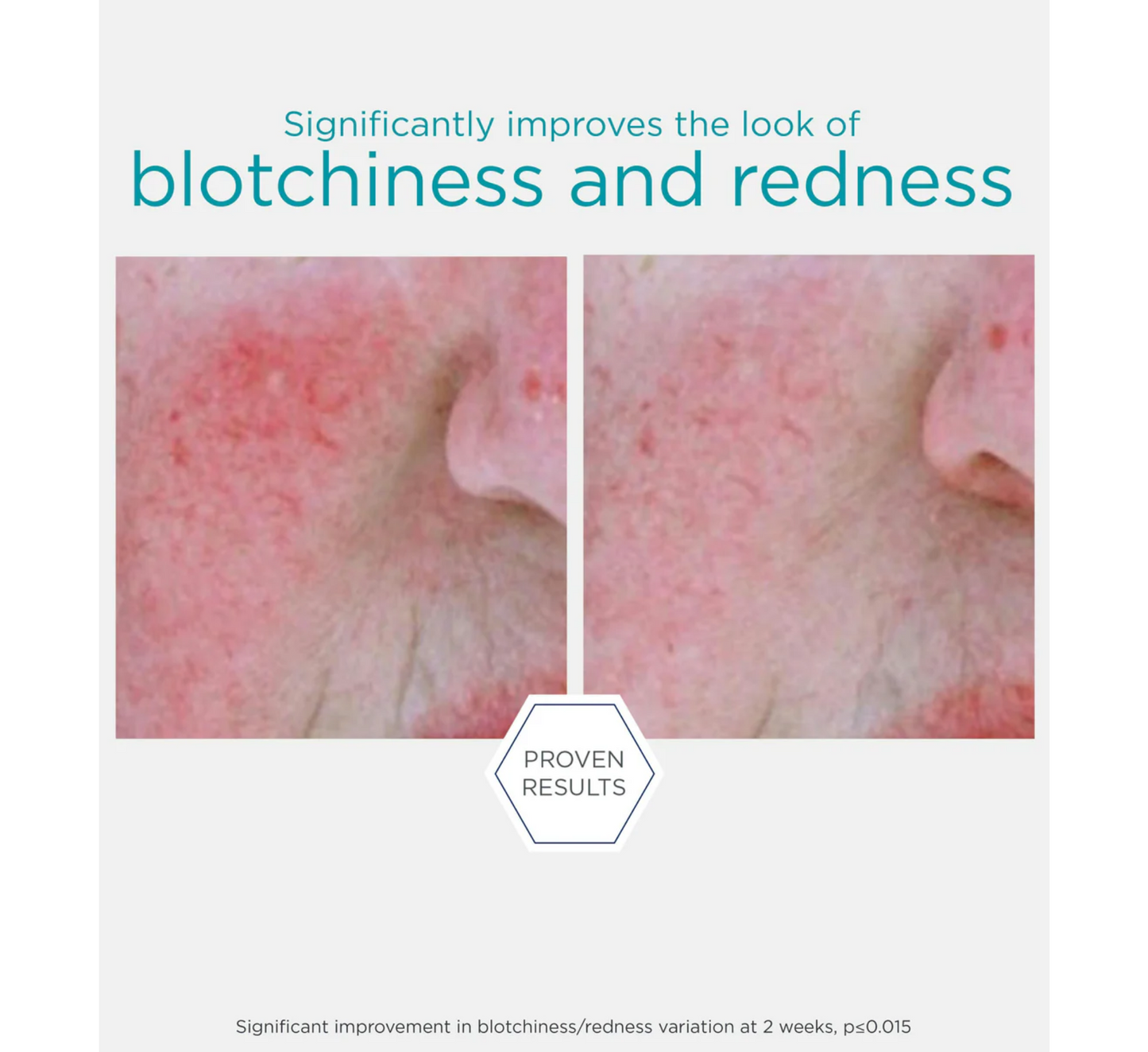 Serum Neutralizues për Rivendosjen e Skuqjes NEOSTRATA *29g